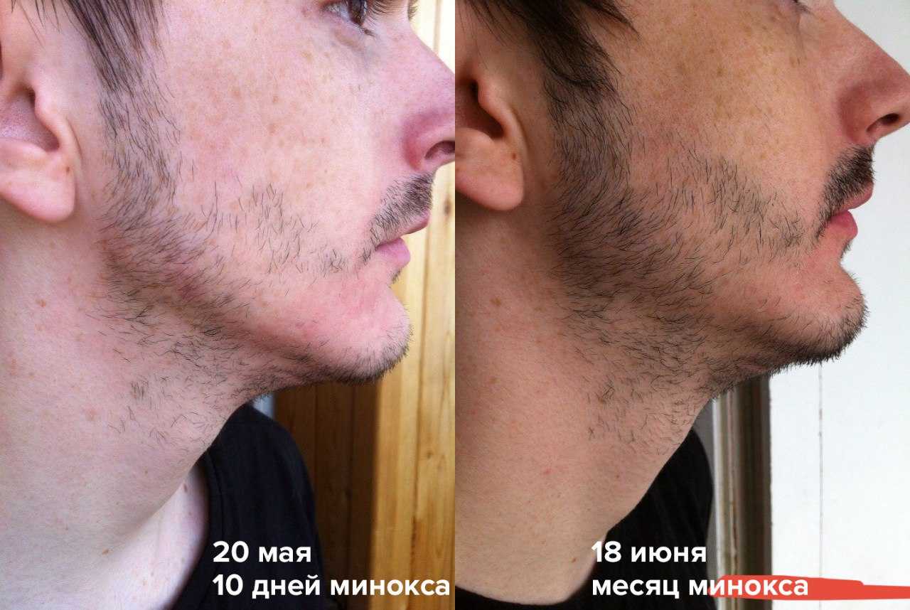 Как повысить тестостерон у мужчин чтобы росла борода